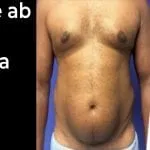 Fake Ab Surgery