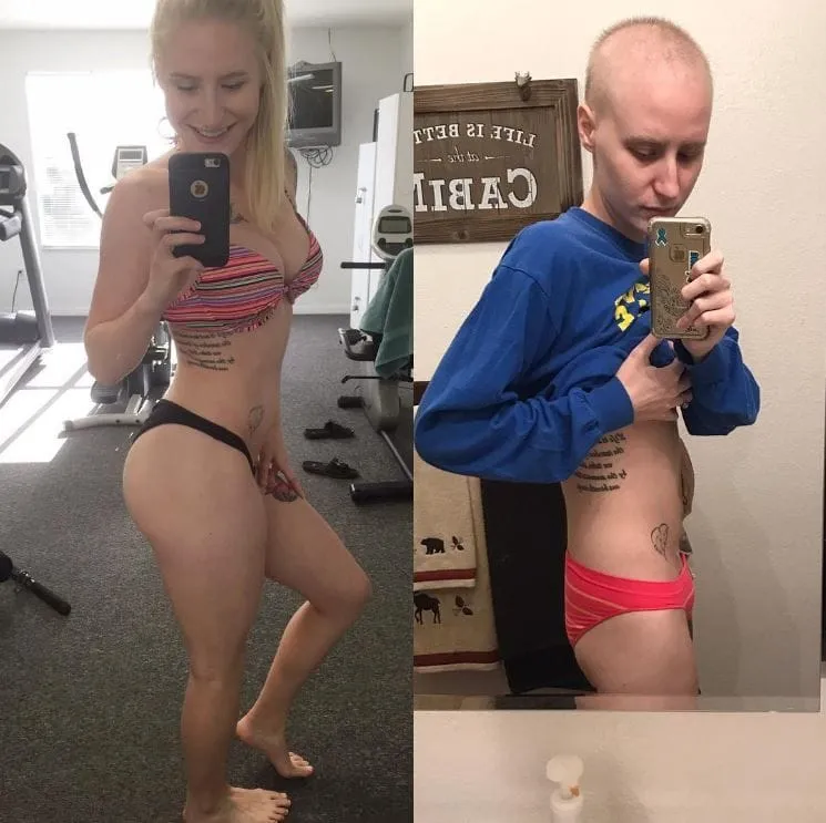 23 Year old Female Bodybuilder suffers from Ovarian Cancer