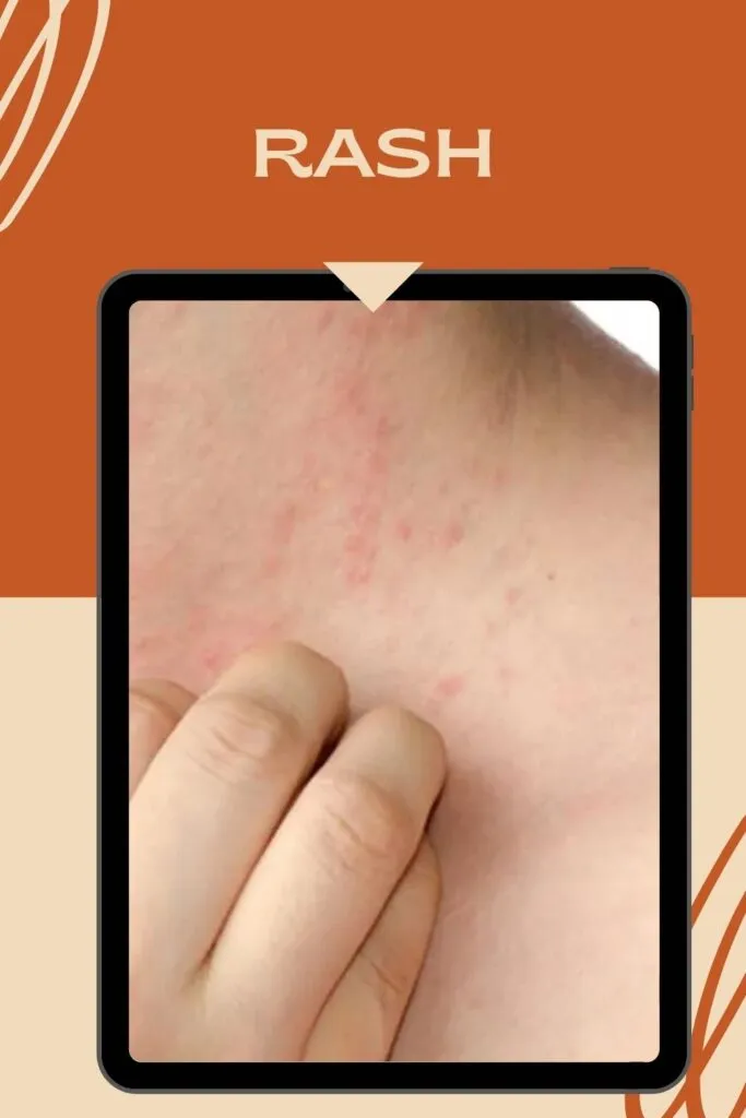 Some one is showing rash on the skin Some one is showing rash on the skin - Skin Blemishes meaning