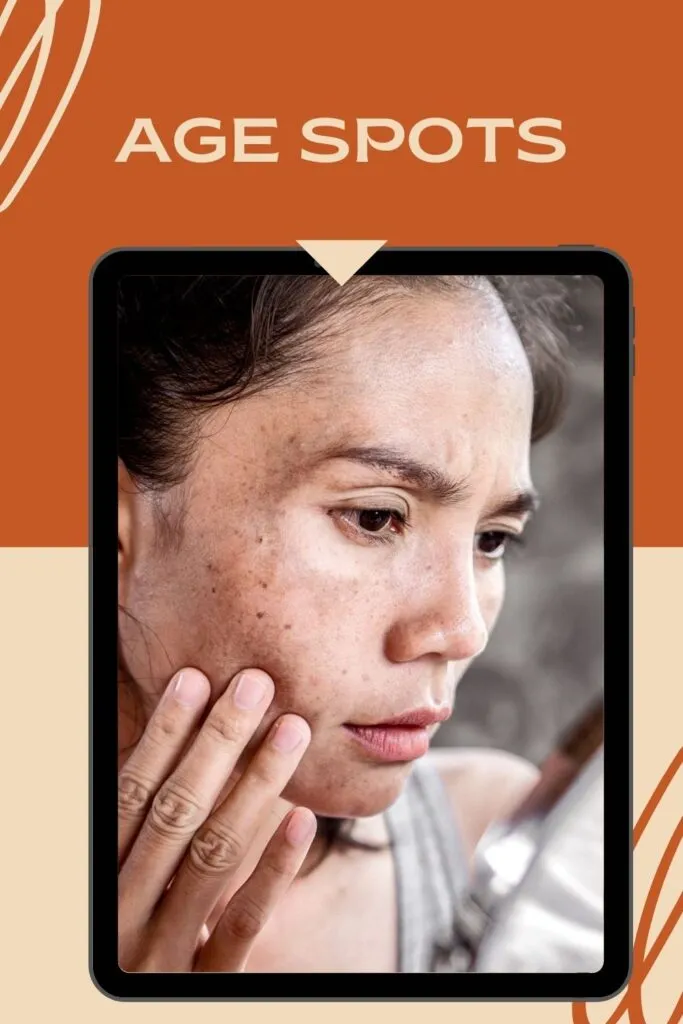 A lady is showing age spots on her face A lady is showing age spots on her face - Skin Blemishes types