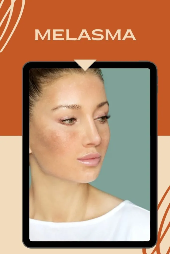 Lady is showing her melasma spots Lady is showing her melasma spots - tips for face care