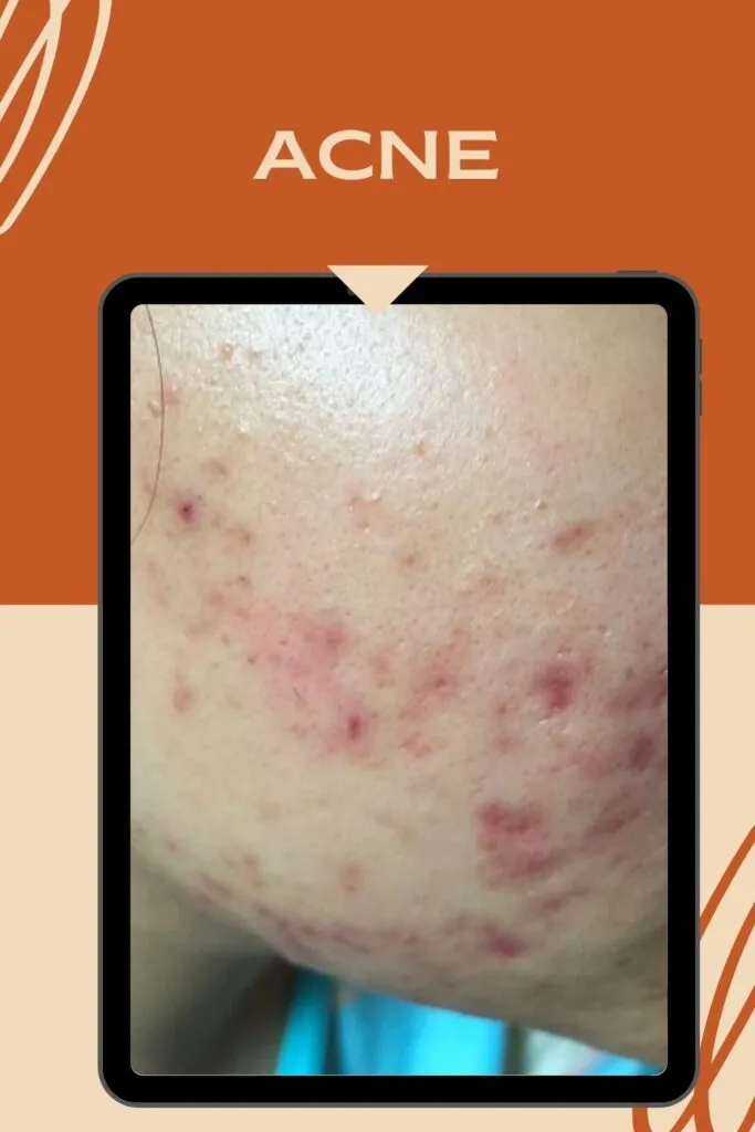 how acne looks alike how acne looks alike - Skin Blemishes