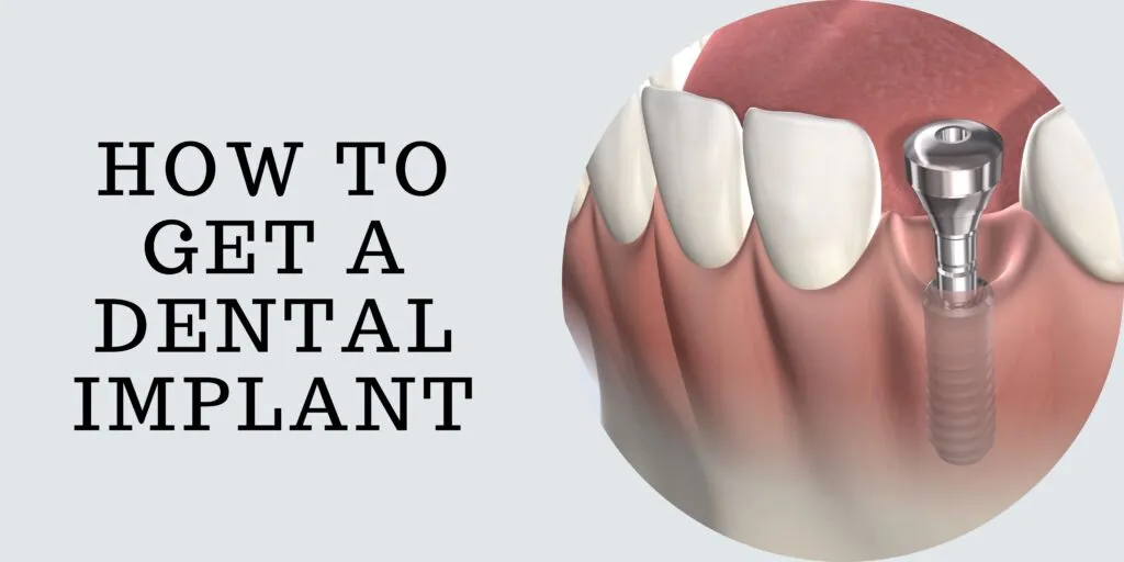 The Pros and Cons of Getting Dental Implants