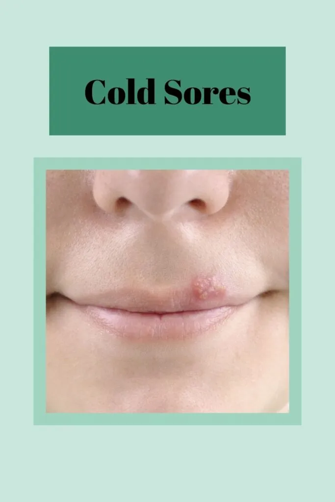 A women is showing cold sores on her lips A women is showing cold sores on her lips - lip care home remedies