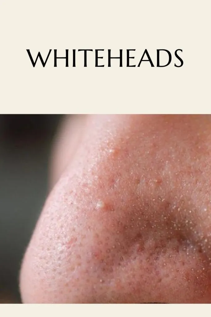 Someone his showing his whiteheads - remove pimple tips