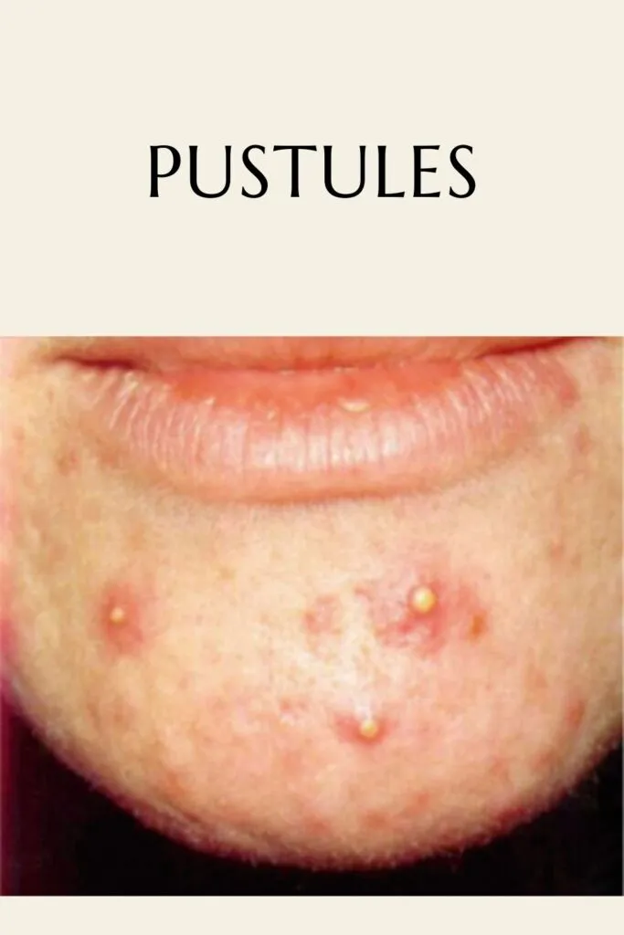 Someone is showing her pustules acne - glowing skin