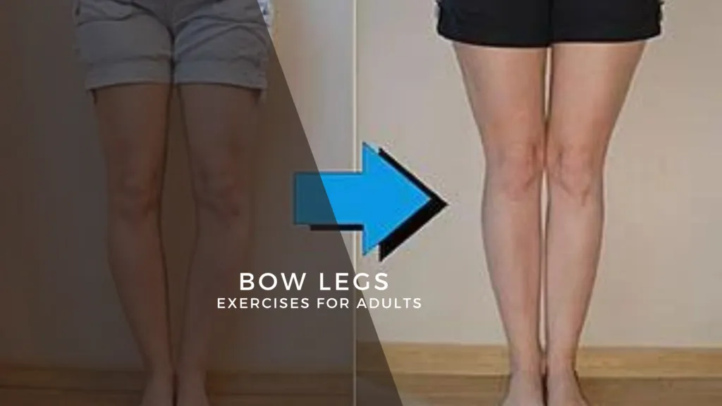 Bow Legs Correction Exercises for Adults