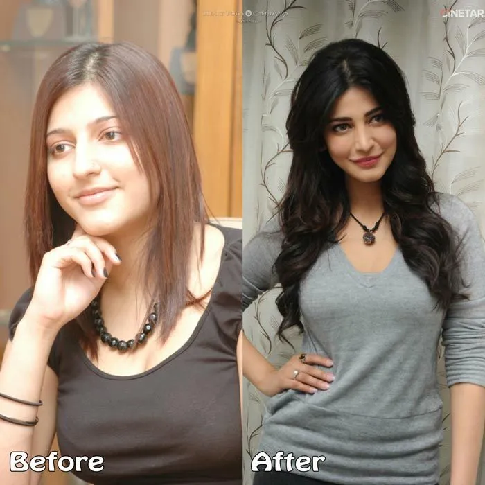 Shruti Haasan before and after pics of cosmetic surgery Shruti Haasan before and after pics of cosmetic surgery - bollywood cosmetic surgery revealed
