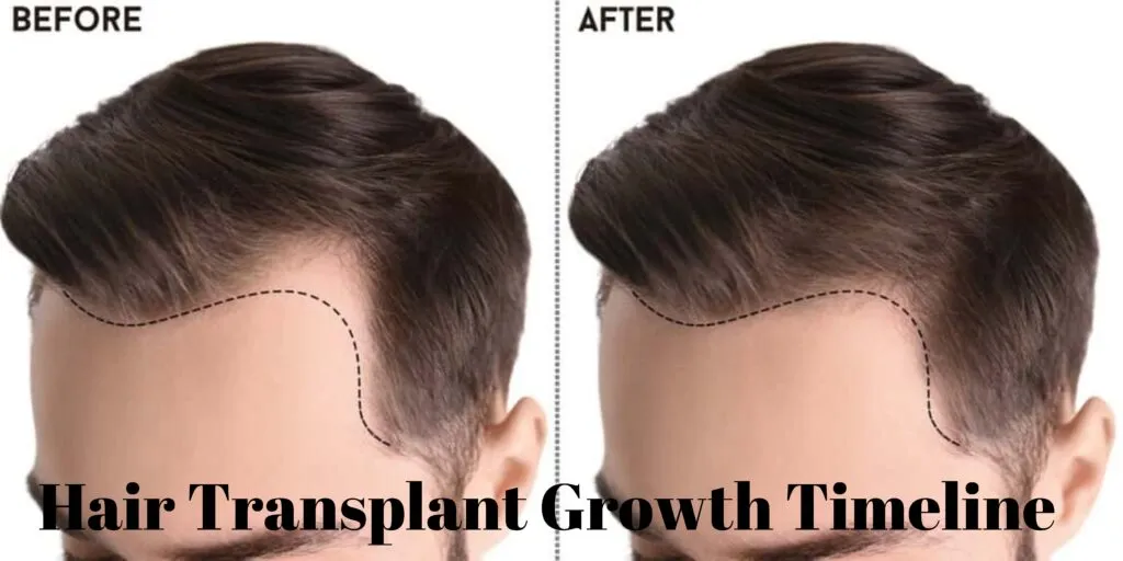 Hair Transplant Growth Timeline
